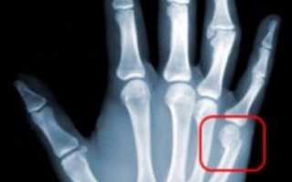 Перелом пальца на руке